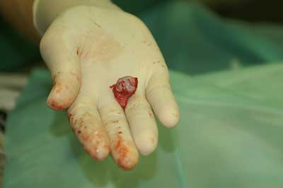 nach der Fraktur entfernter Gelenkkopf